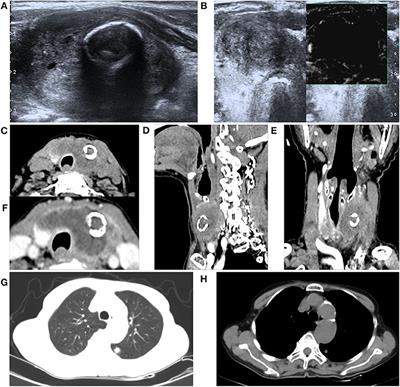 A Primary Squamous Cell Carcinoma of the Thyroid Presenting as the Anaplastic Thyroid Carcinoma: A Case Report